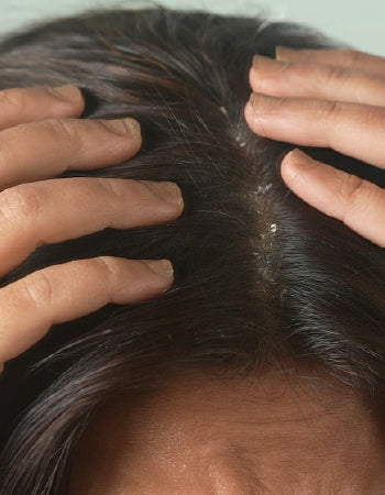 How To Remove Dandruff From Hair