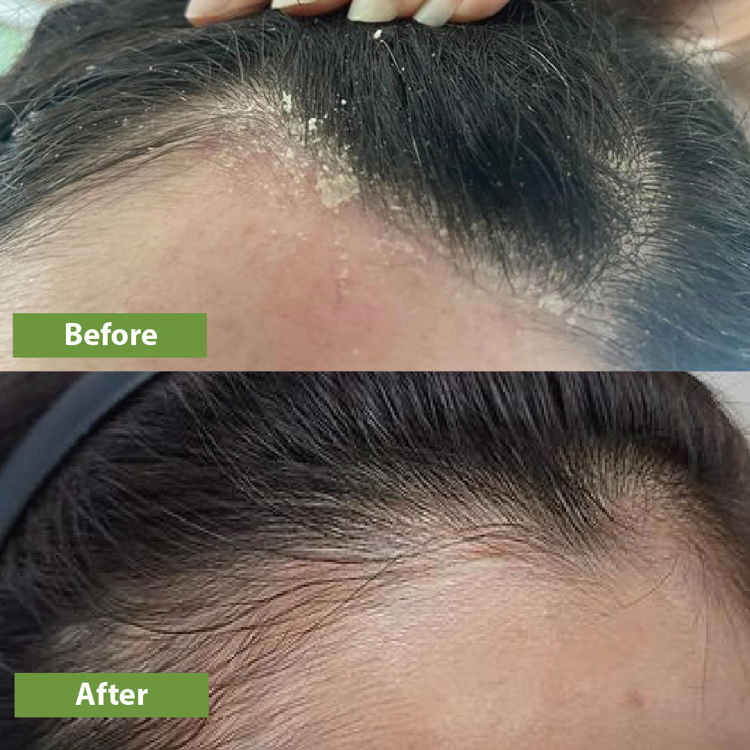 Anti-Dandruff Hair Oil